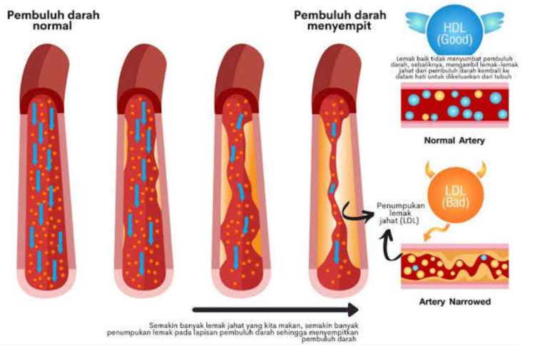BAHAYA PLAK PEMBULUH DARAH